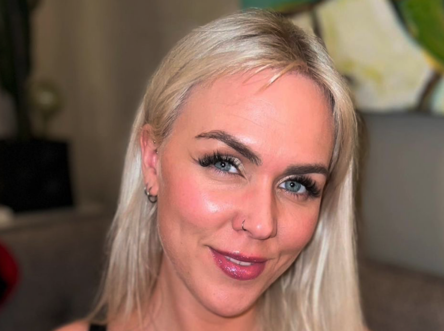 Steinunn hårtransplantasjon